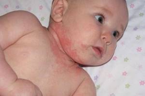 симптомы аллергической сыпи у детей