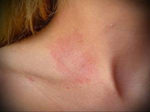 симптомы аллергии у взрослых