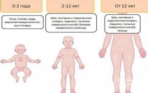 Симптомы атопического дерматита у детей разного возраста