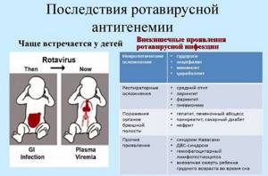 Симптомы и лечение ротавирусной кишечной инфекции у детей