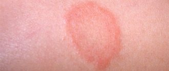 Photo of pityriasis rosea