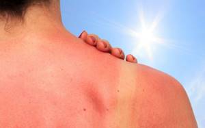 Солнечная аллергия у взрослых