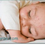 Сыпь на голове у грудного ребенка причины