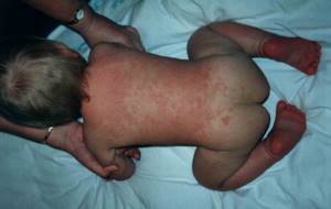 Сыпь на спине у ребенка – виды, причины появления и методы лечения. Сыпь на спине у ребенка — откуда берутся красные прыщи