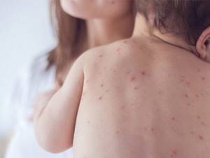 Сыпь на спине у ребенка – виды, причины появления и методы лечения. Сыпь на спине у ребенка — откуда берутся красные прыщи