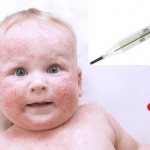 Температура при аллергии у детей: бывает ли