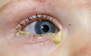 Тобрекс глазные капли для детей и новорожденных