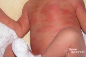 Токсическая эритема - заболевание, свойственное новорожденным младенцам