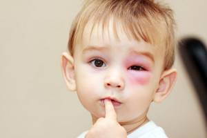 Травма глаза у ребенка