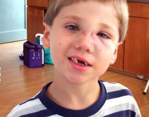 Травма носа у ребенка через несколько дней после несчастного случая