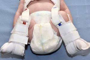 У ребенка несимметричные складки на ножках: причины, норма и отклонения, мнения медиков