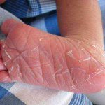 у ребенка шелушится кожа на руках причины и лечение