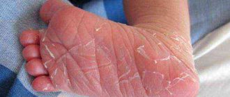 The child's skin is peeling on his hands: causes and treatment