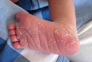 у ребенка шелушится кожа на руках причины и лечение