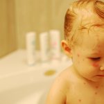 ванна при ветрянке