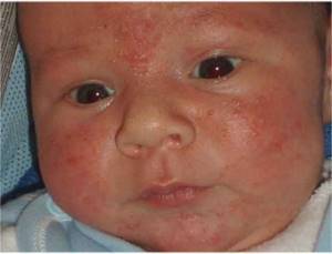 Везикулопустулез у новонароджених: збудники, симптоми і лікування ...