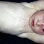 Вирусная экзантема