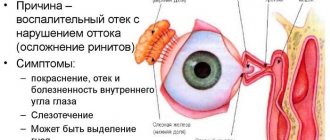 Inflammation of the lacrimal sac