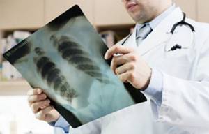 Врач держит в руках рентгеновский снимок легких