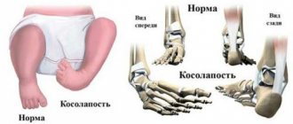 Congenital clubfoot