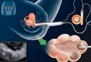 выделения после переноса эмбрионов в удачном протоколе
