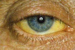 Желтые белки глаз у новорожденного